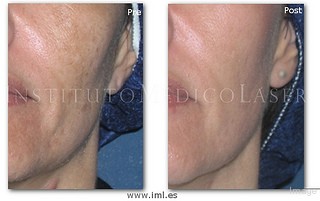 Melasma Treatment Options